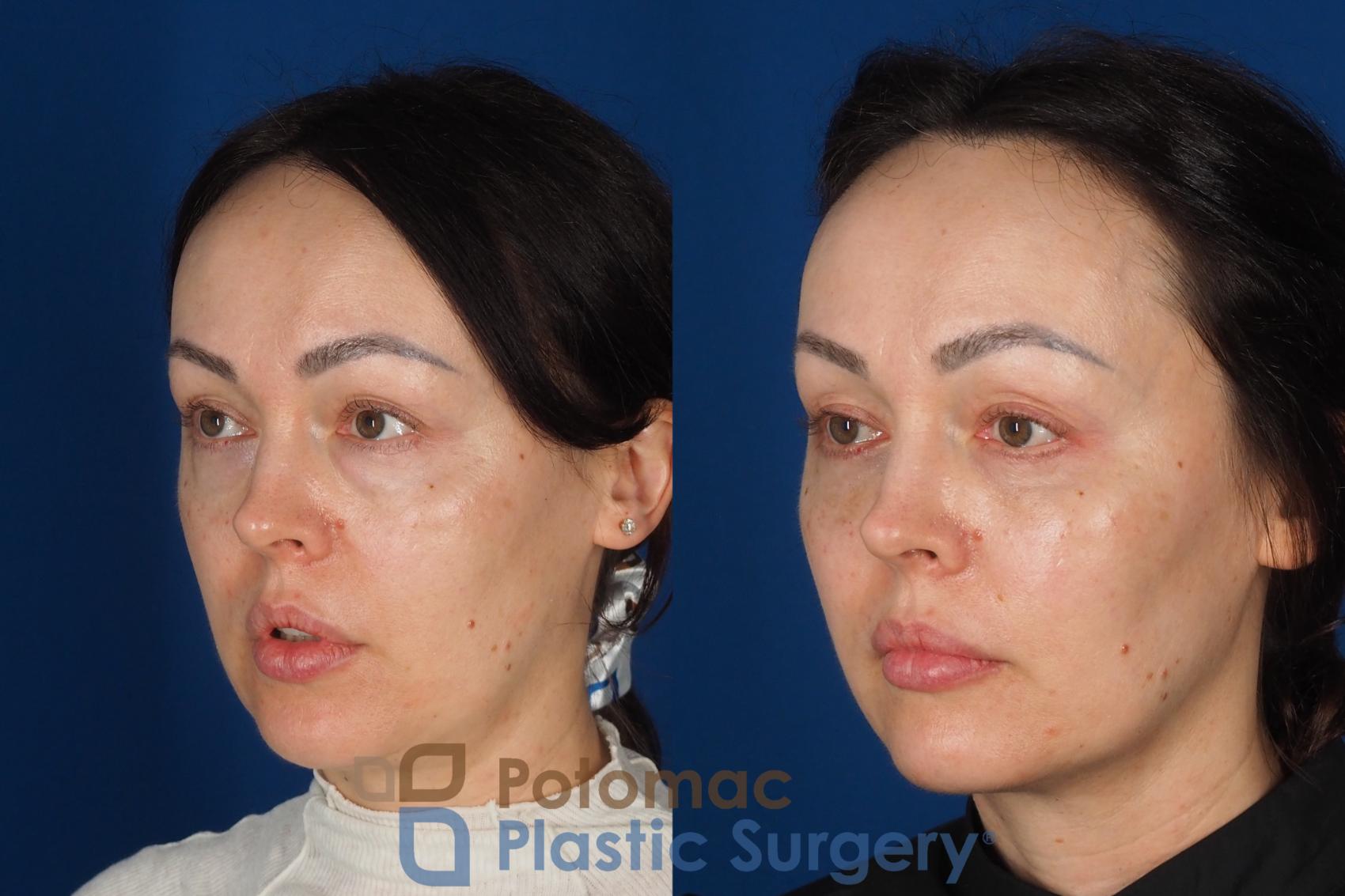 Before & After Fat Transfer Case 340 Left Oblique View in Washington DC & Arlington , DC