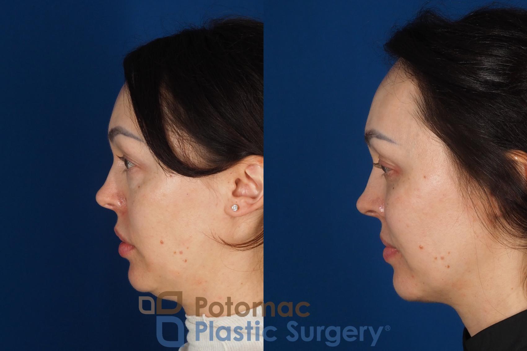 Before & After Fat Transfer Case 340 Left Side View in Washington DC & Arlington , DC