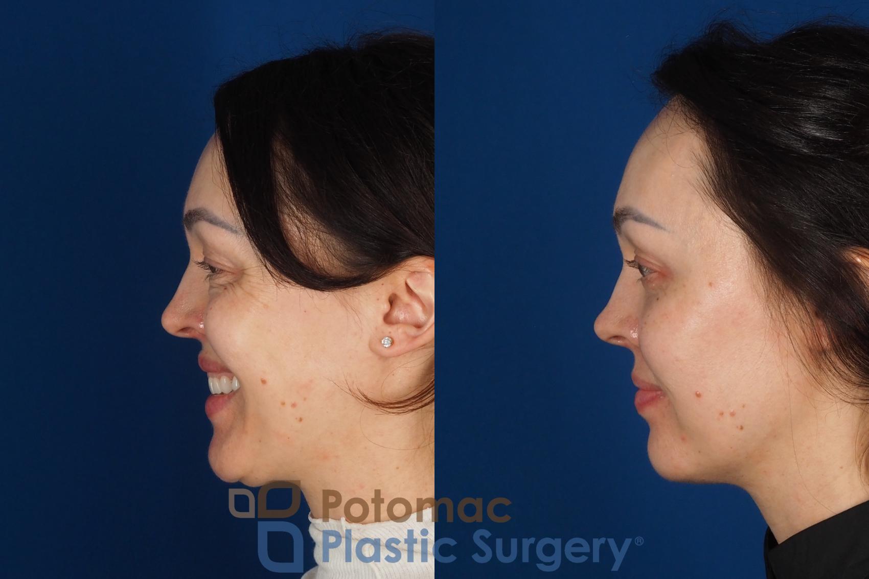 Before & After Fat Transfer Case 340 Left - Smiling View in Washington DC & Arlington , DC