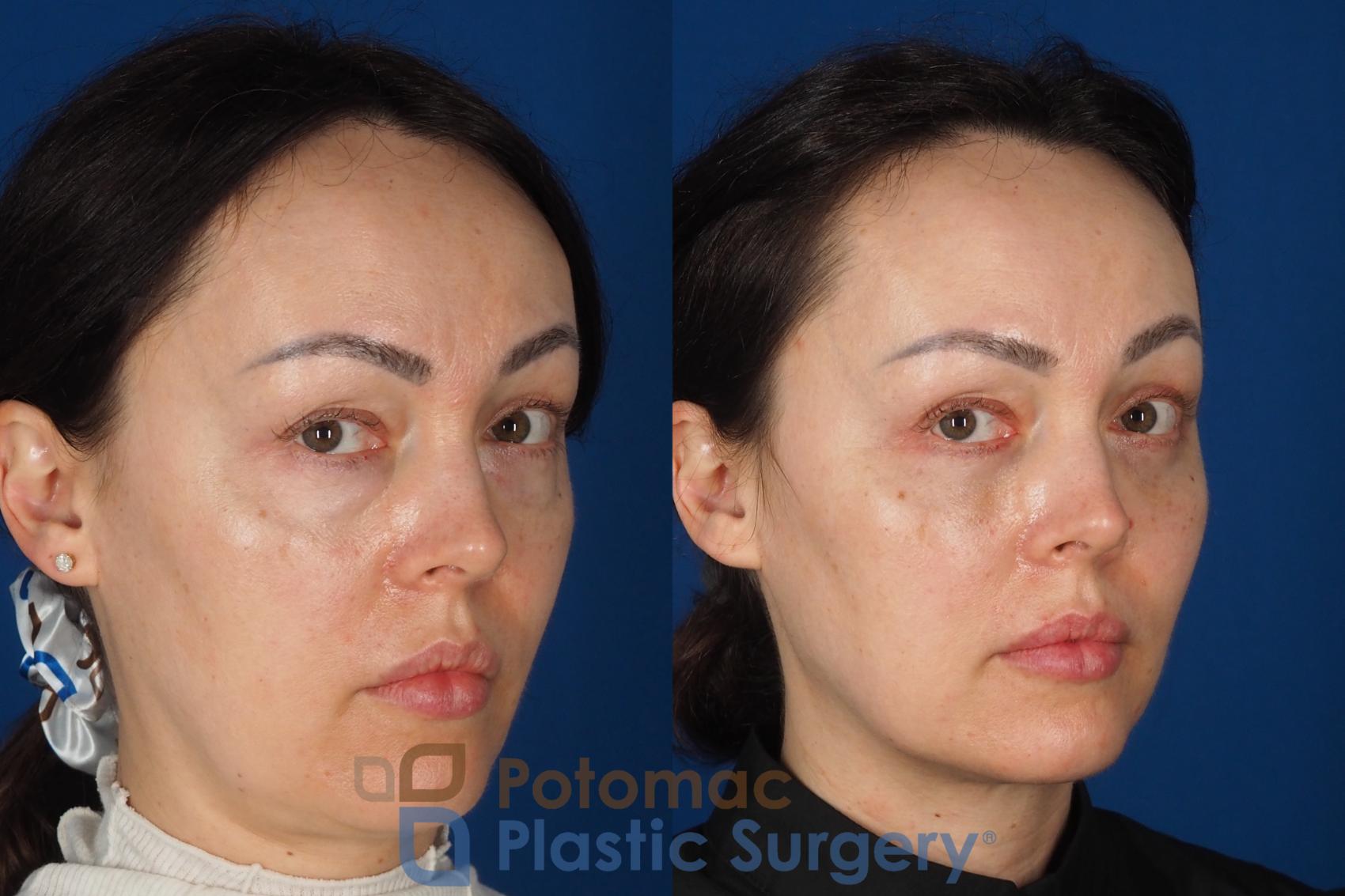 Before & After Fat Transfer Case 340 Right Oblique 2 View in Washington DC & Arlington , DC