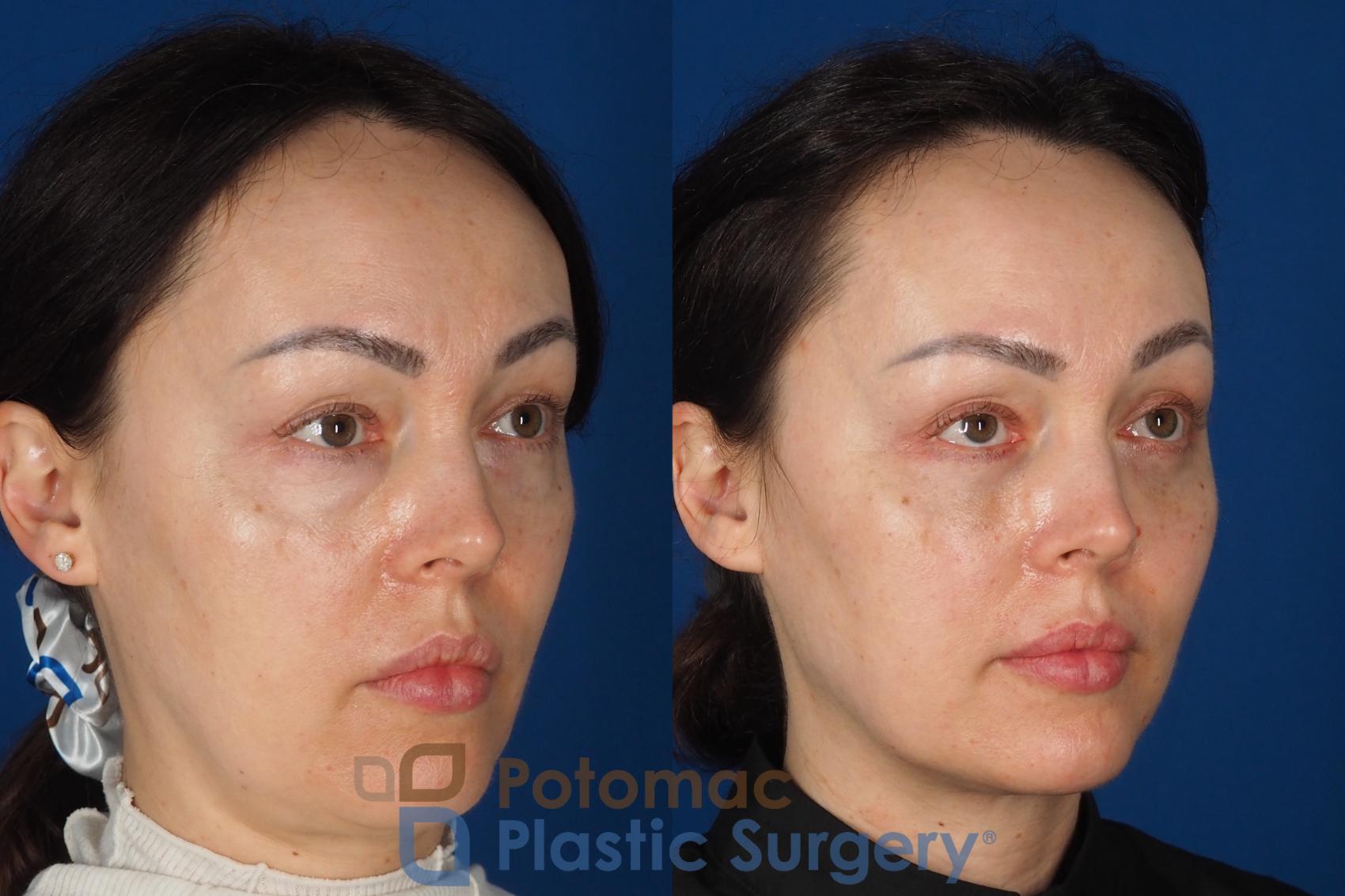 Before & After Fat Transfer Case 340 Right Oblique View in Washington DC & Arlington , DC