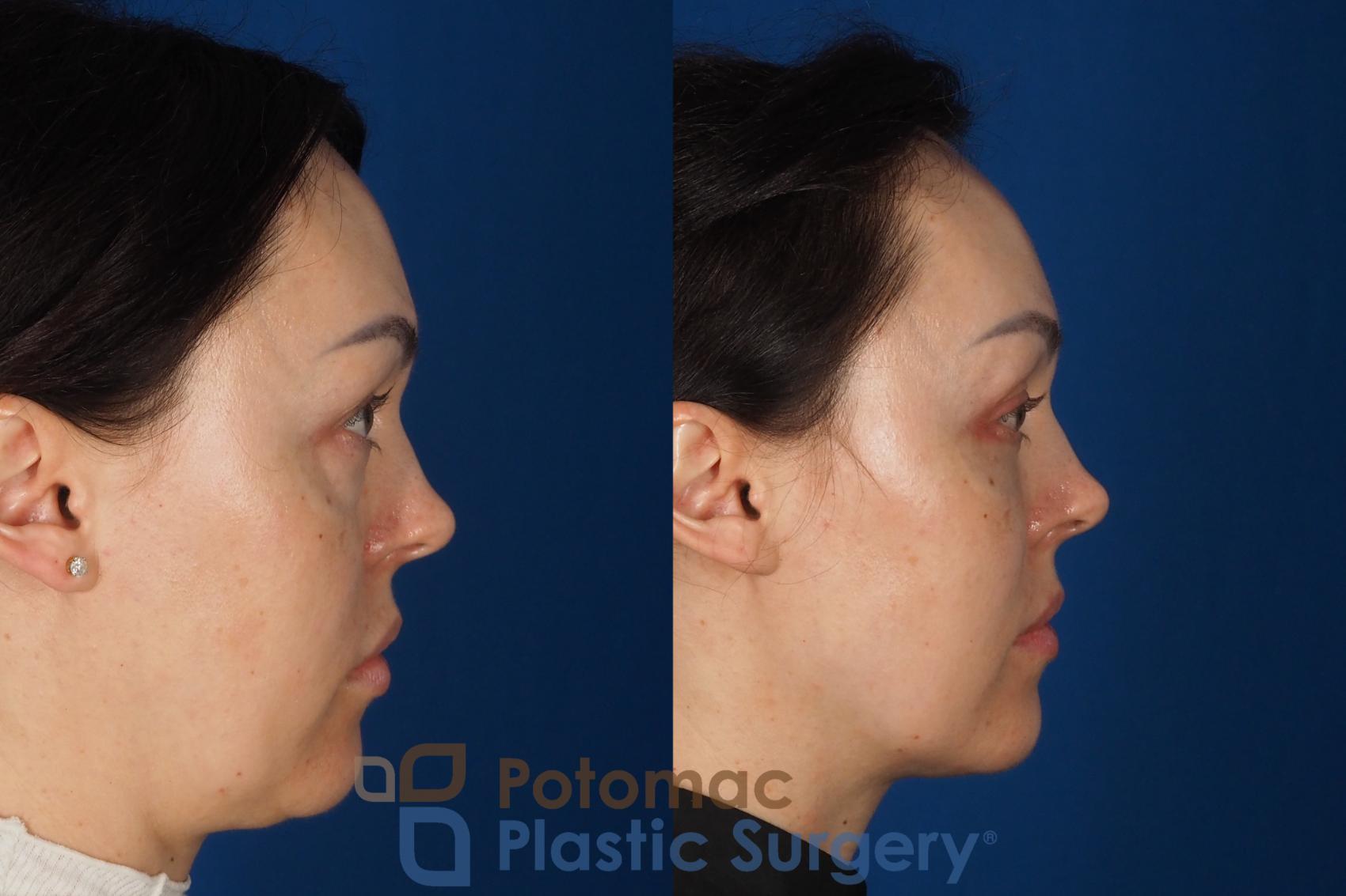 Before & After Fat Transfer Case 340 Right Side View in Washington DC & Arlington , DC