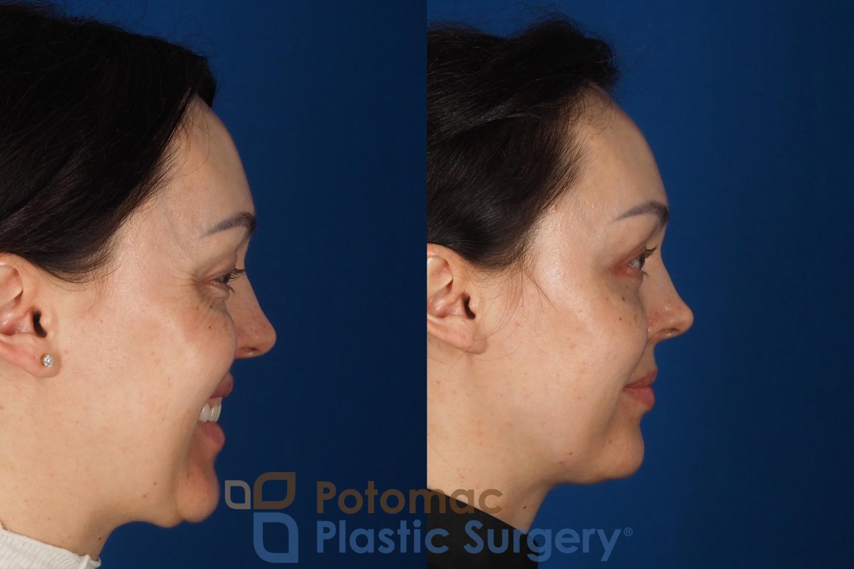 Before & After Fat Transfer Case 340 Right - Smiling View in Washington DC & Arlington , DC