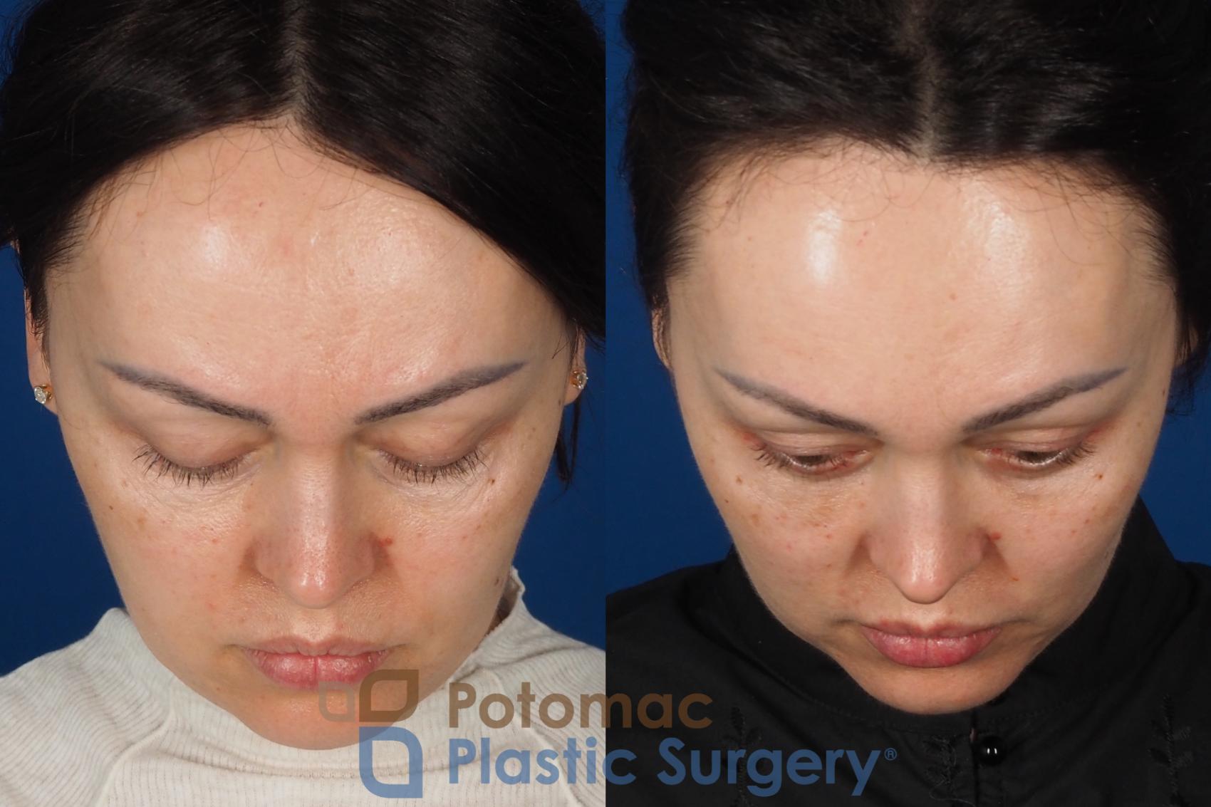 Before & After Fat Transfer Case 340 Top View in Washington DC & Arlington , DC