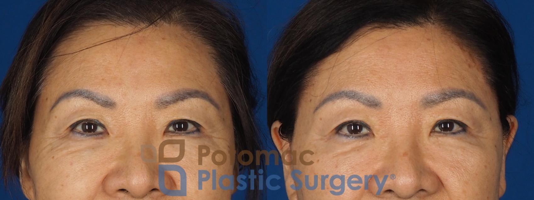 Before & After Blepharoplasty (Eyelid Surgery) Case 347 Front - Smiling View in Washington DC & Arlington , DC