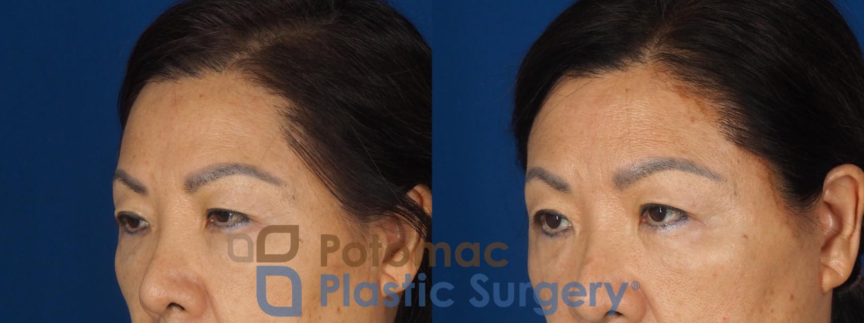 Before & After Blepharoplasty (Eyelid Surgery) Case 347 Left Oblique View in Washington DC & Arlington , DC