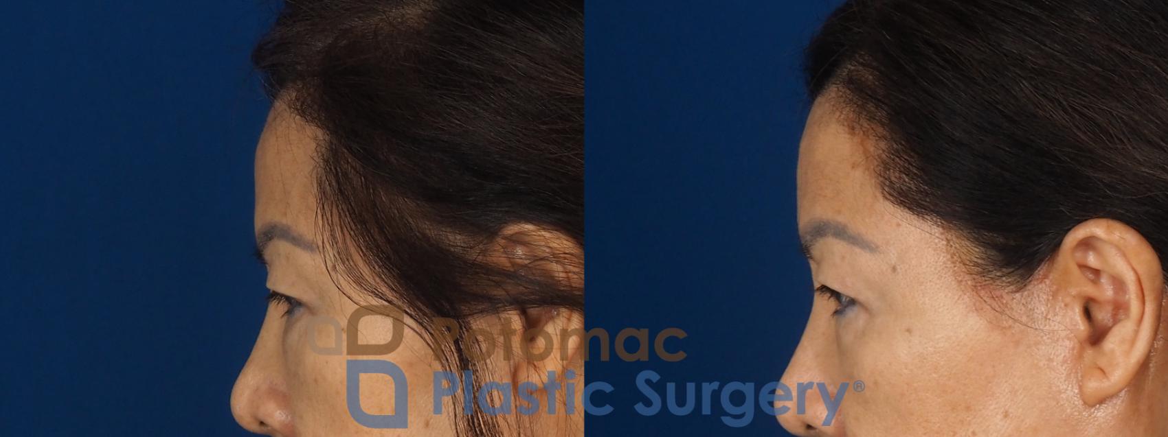 Before & After Blepharoplasty (Eyelid Surgery) Case 347 Left Side View in Washington DC & Arlington , DC