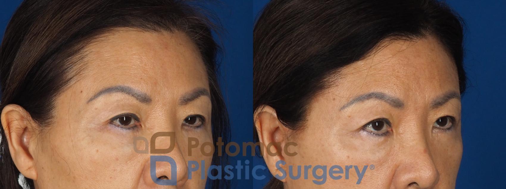 Before & After Blepharoplasty (Eyelid Surgery) Case 347 Right Oblique View in Washington DC & Arlington , DC