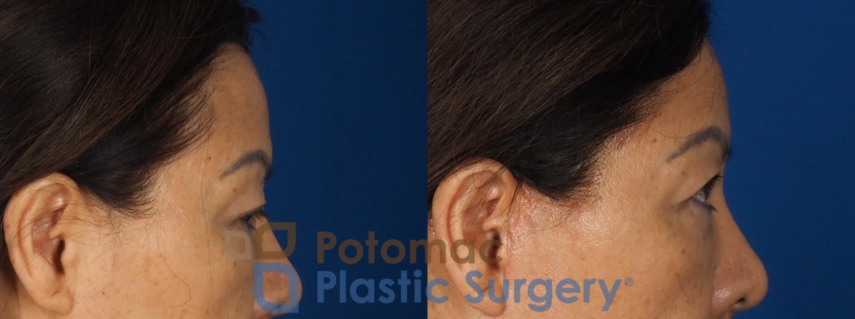 Before & After Blepharoplasty (Eyelid Surgery) Case 347 Right Side View in Washington DC & Arlington , DC