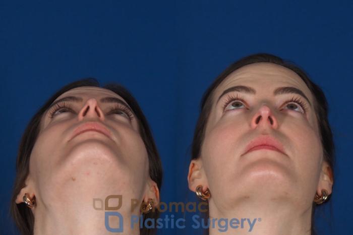 Before & After Facial Sculpting Case 355 Bottom View in Washington DC & Arlington , DC