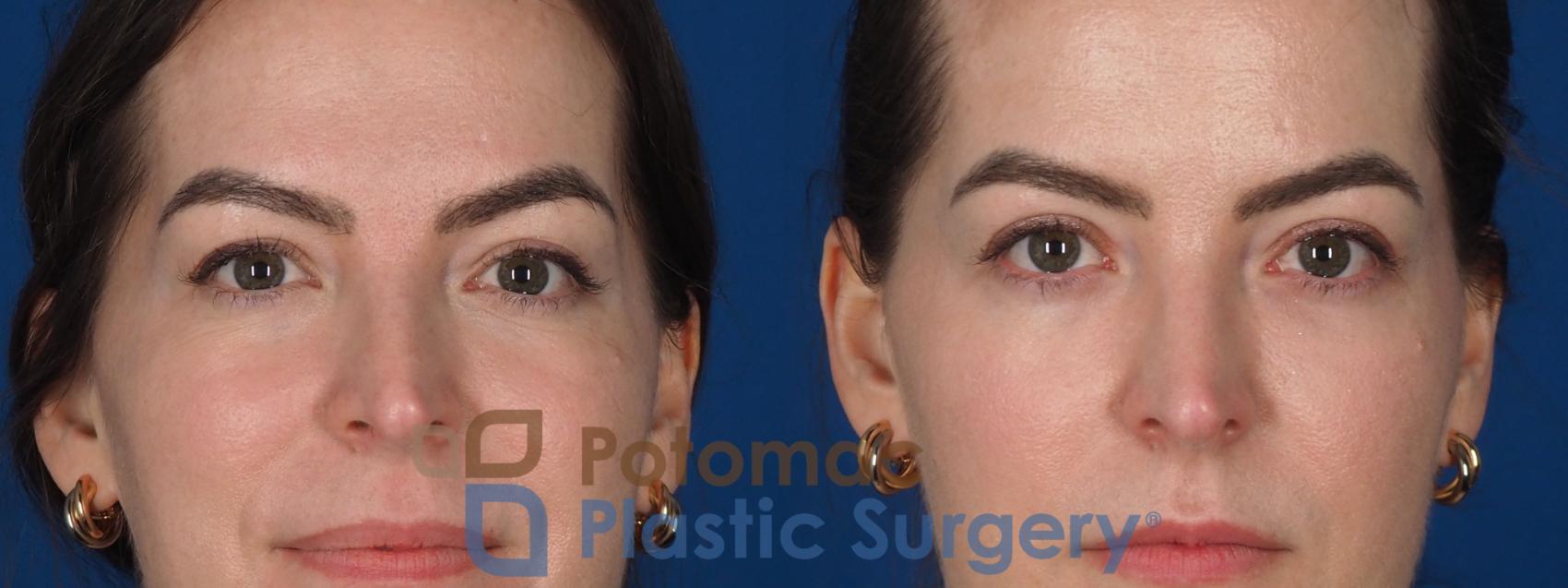 Before & After Facial Sculpting Case 355 Front 2 View in Washington DC & Arlington , DC