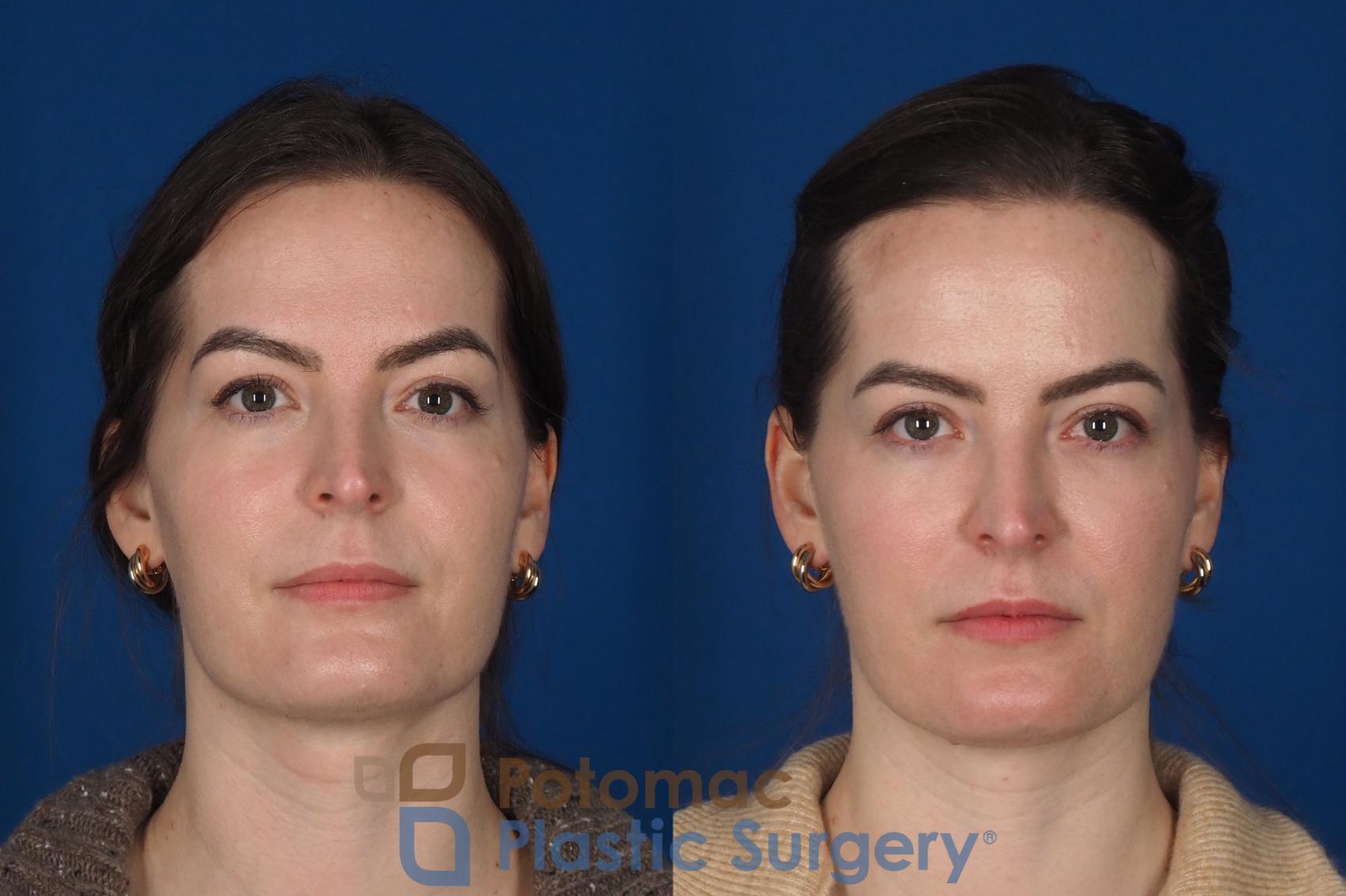 Before & After Facial Sculpting Case 355 Front View in Washington DC & Arlington , DC