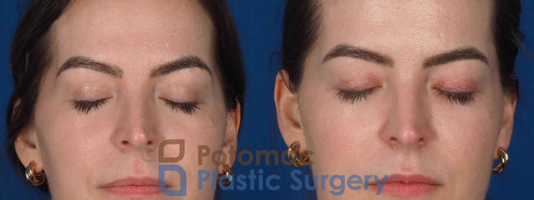 Before & After Facial Sculpting Case 355 Front - Eyes closed View in Washington DC & Arlington , DC