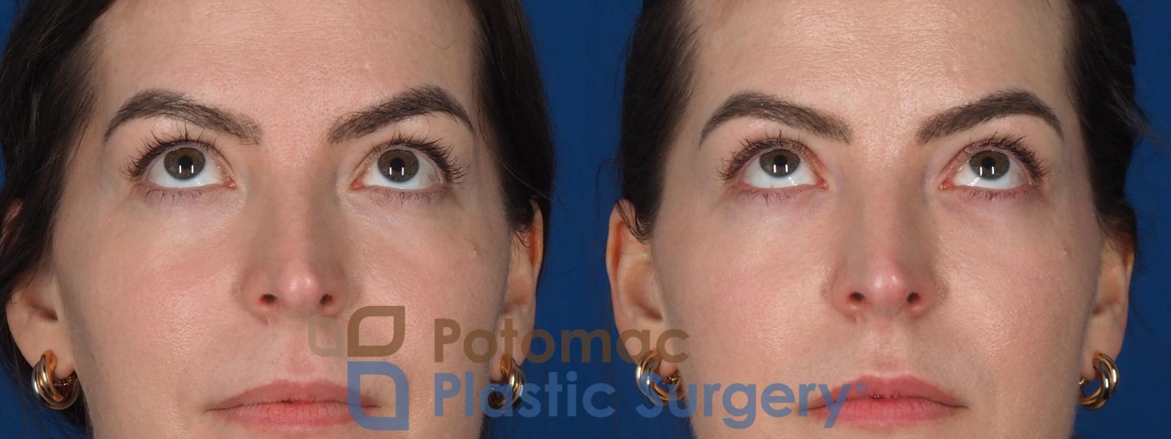 Before & After Facial Sculpting Case 355 Front - Looking Up View in Washington DC & Arlington , DC