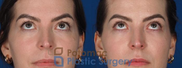 Before & After Facial Sculpting Case 355 Front - Looking Up View in Washington DC & Arlington , DC