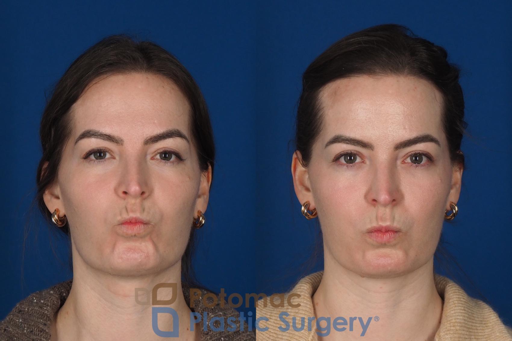 Before & After Facial Sculpting Case 355 Front - Puckering View in Washington DC & Arlington , DC
