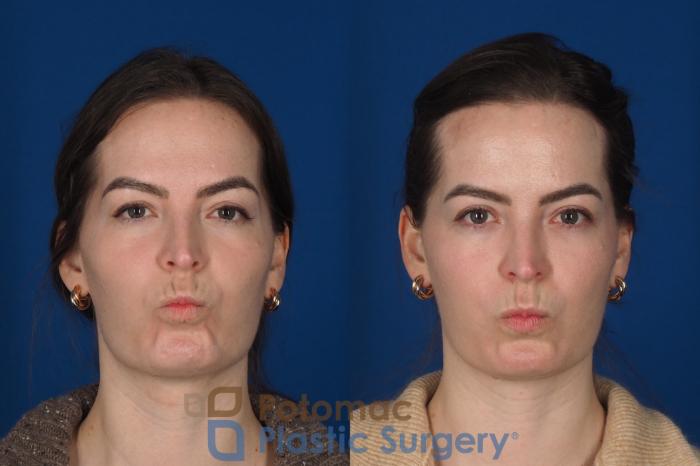 Before & After Facial Sculpting Case 355 Front - Puckering View in Washington DC & Arlington , DC
