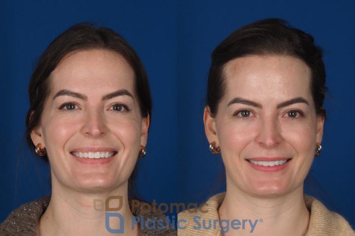 Before & After Facial Sculpting Case 355 Front - Smiling View in Washington DC & Arlington , DC