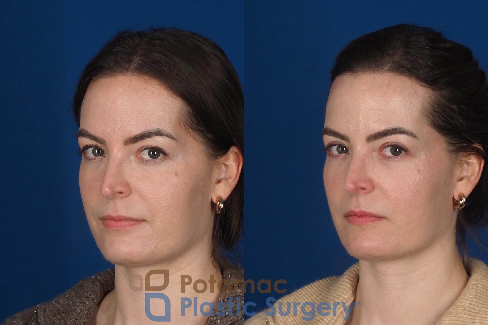 Before & After Facial Sculpting Case 355 Left Oblique 2 View in Washington DC & Arlington , DC