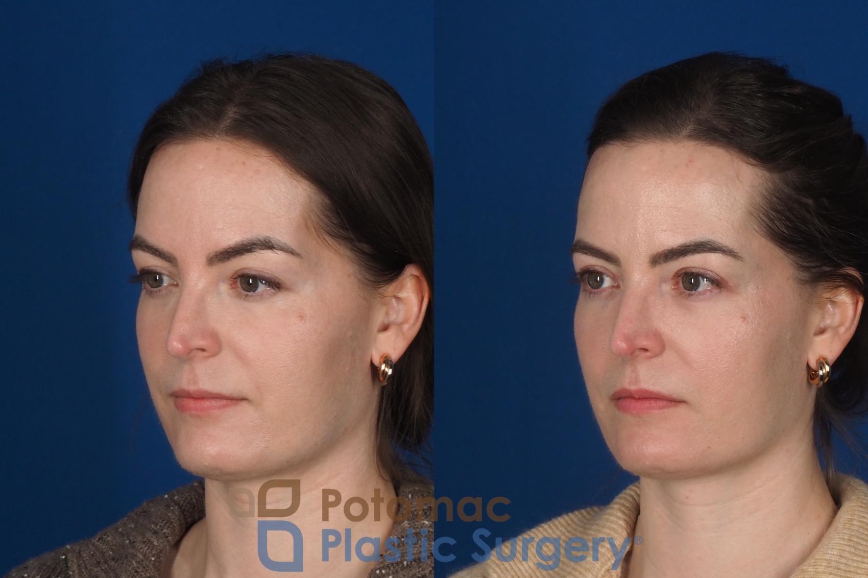 Before & After Facial Sculpting Case 355 Left Oblique View in Washington DC & Arlington , DC