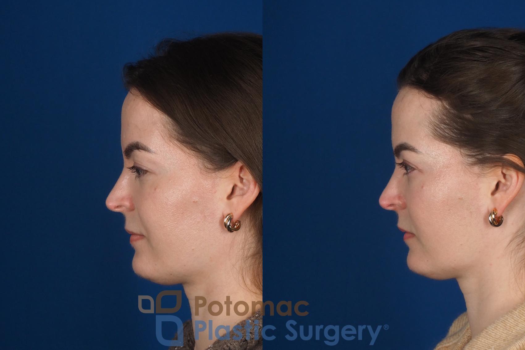 Before & After Facial Sculpting Case 355 Left Side View in Washington DC & Arlington , DC
