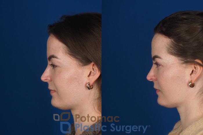 Before & After Facial Sculpting Case 355 Left Side View in Washington DC & Arlington , DC