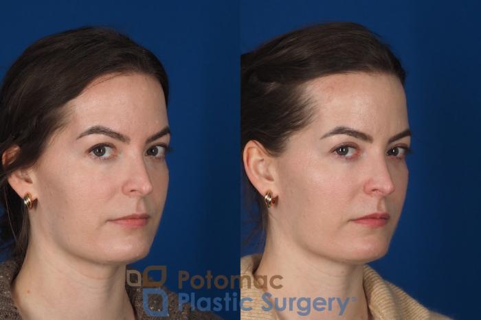Before & After Facial Sculpting Case 355 Right Oblique 2 View in Washington DC & Arlington , DC
