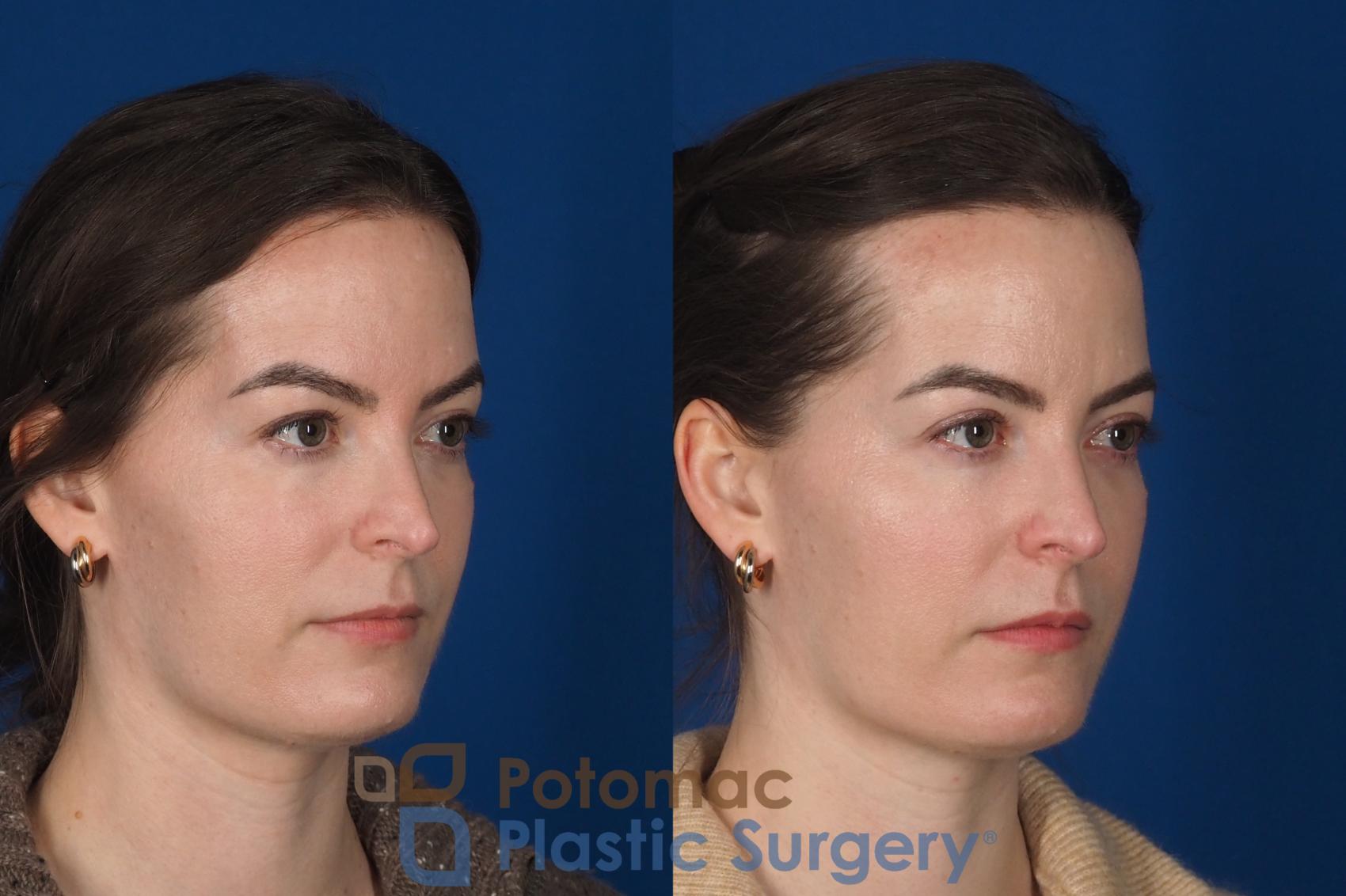 Before & After Facial Sculpting Case 355 Right Oblique View in Washington DC & Arlington , DC
