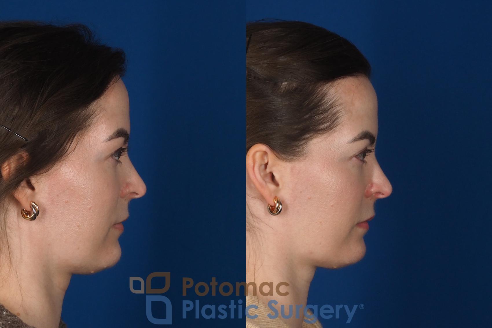 Before & After Facial Sculpting Case 355 Right Side View in Washington DC & Arlington , DC