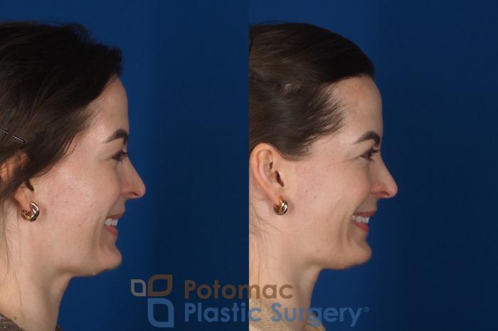 Before & After Facial Sculpting Case 355 Right - Smiling View in Washington DC & Arlington , DC
