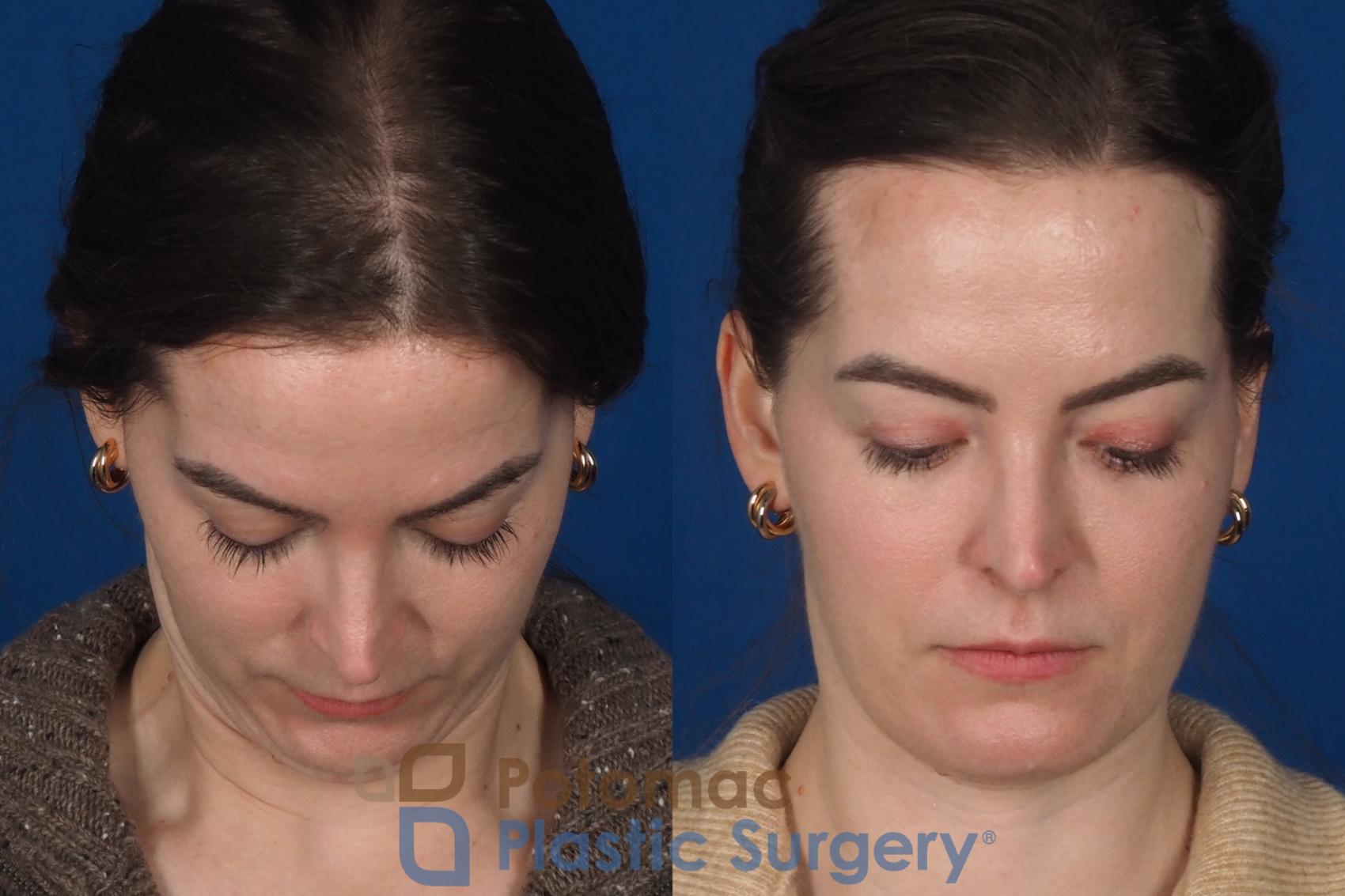 Before & After Facial Sculpting Case 355 Top View in Washington DC & Arlington , DC