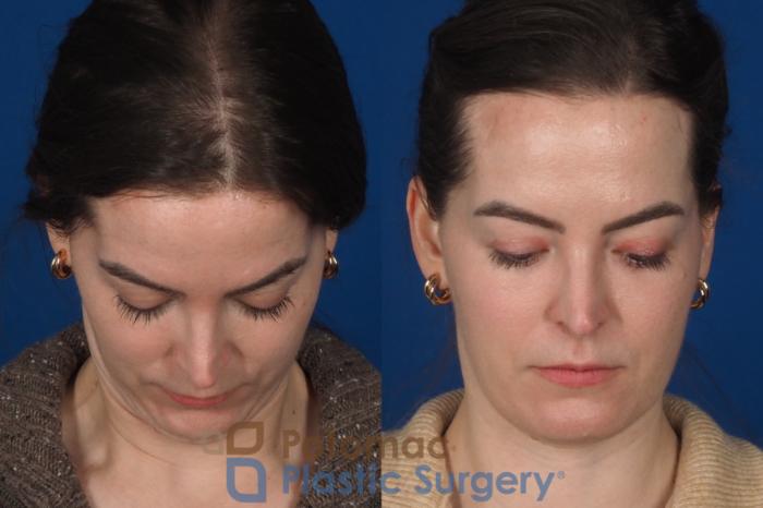 Before & After Facial Sculpting Case 355 Top View in Washington DC & Arlington , DC