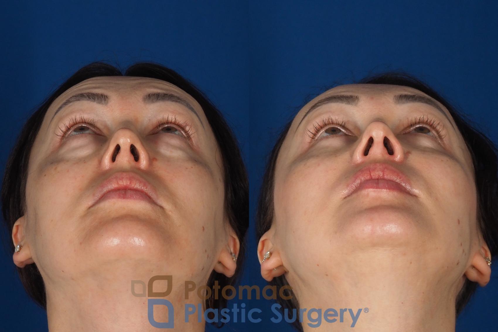 Before & After Blepharoplasty (Eyelid Surgery) Case 356 Bottom View in Washington DC & Arlington , DC