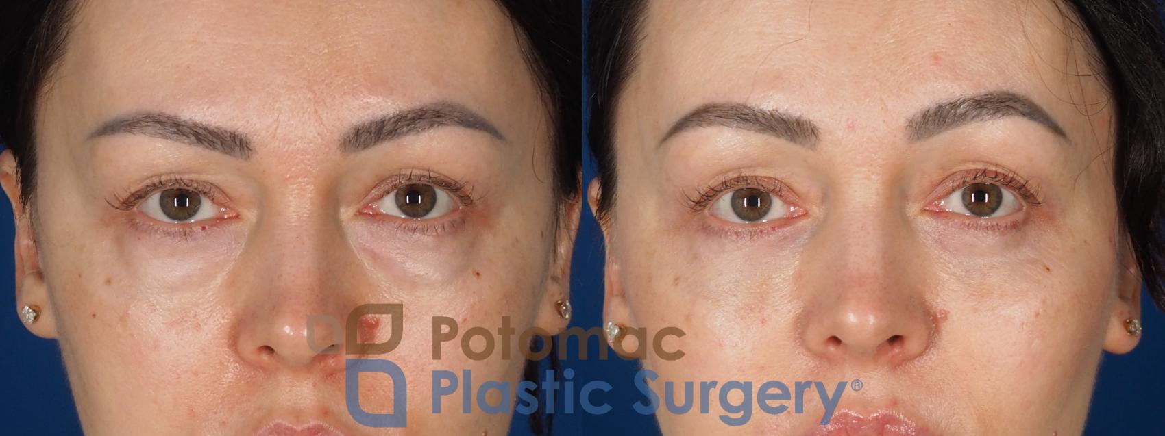 Before & After Blepharoplasty (Eyelid Surgery) Case 356 Front 2 View in Washington DC & Arlington , DC