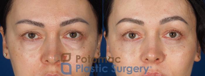 Before & After Blepharoplasty (Eyelid Surgery) Case 356 Front 2 View in Washington DC & Arlington , DC