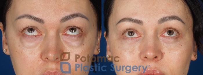Before & After Blepharoplasty (Eyelid Surgery) Case 356 Front - Looking Up View in Washington DC & Arlington , DC