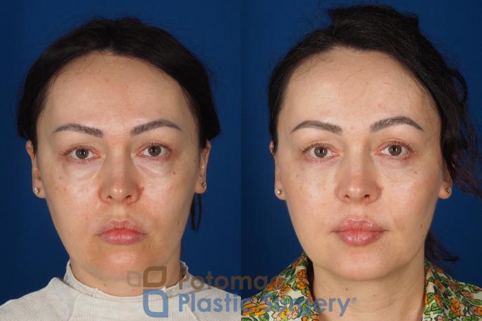 Before & After Blepharoplasty (Eyelid Surgery) Case 356 Front View in Washington DC & Arlington , DC