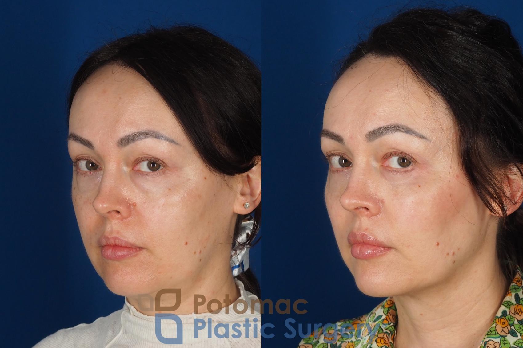 Before & After Blepharoplasty (Eyelid Surgery) Case 356 Left Oblique 2 View in Washington DC & Arlington , DC