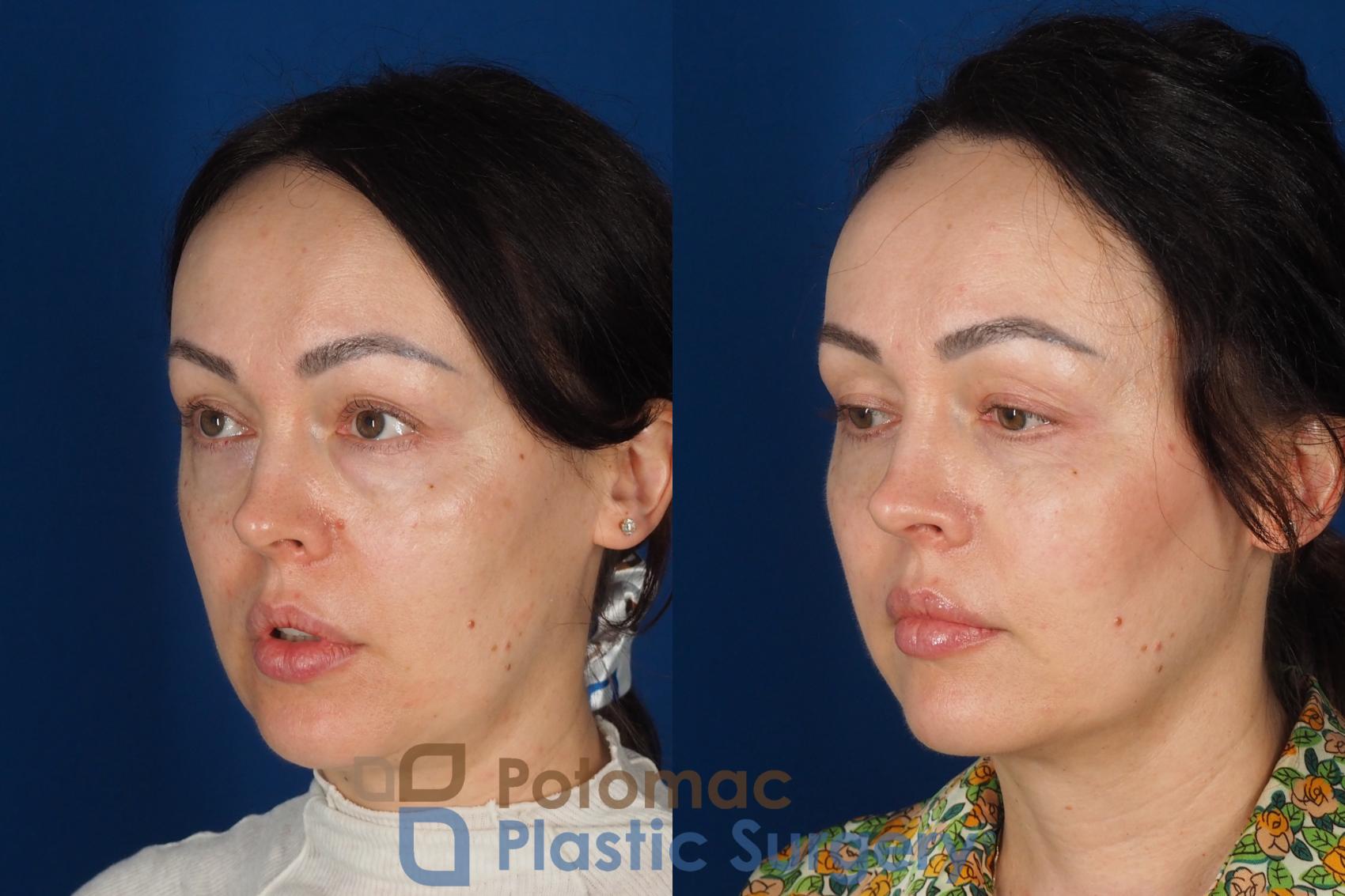 Before & After Blepharoplasty (Eyelid Surgery) Case 356 Left Oblique View in Washington DC & Arlington , DC