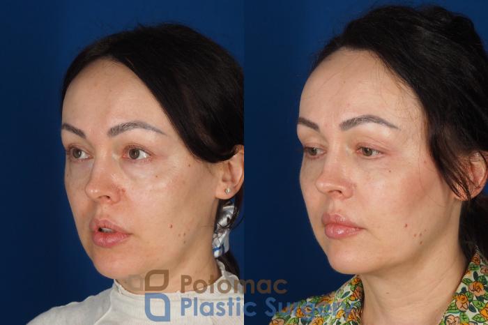 Before & After Blepharoplasty (Eyelid Surgery) Case 356 Left Oblique View in Washington DC & Arlington , DC
