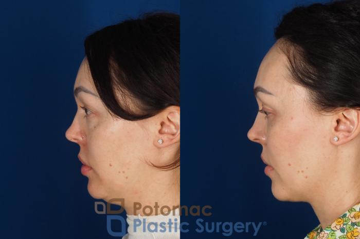 Before & After Blepharoplasty (Eyelid Surgery) Case 356 Left Side View in Washington DC & Arlington , DC