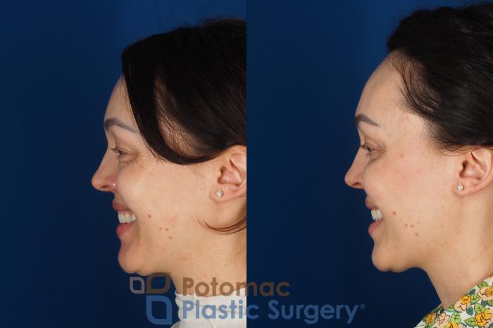Before & After Blepharoplasty (Eyelid Surgery) Case 356 Left - Smiling View in Washington DC & Arlington , DC