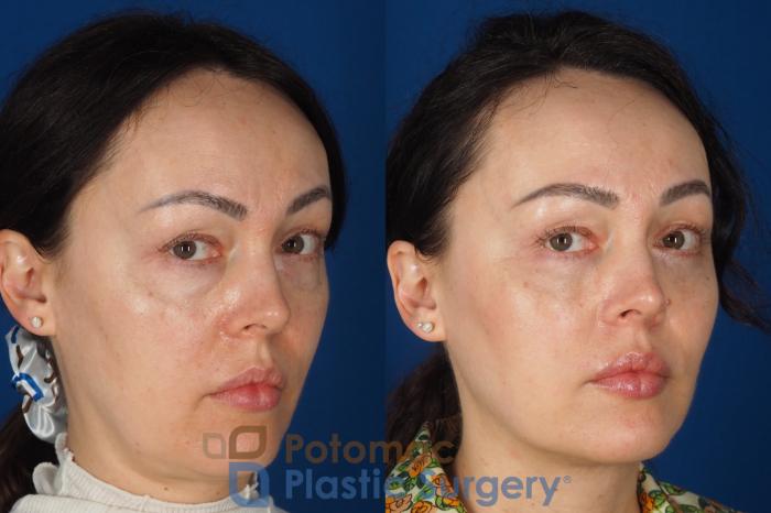 Before & After Blepharoplasty (Eyelid Surgery) Case 356 Right Oblique 2 View in Washington DC & Arlington , DC