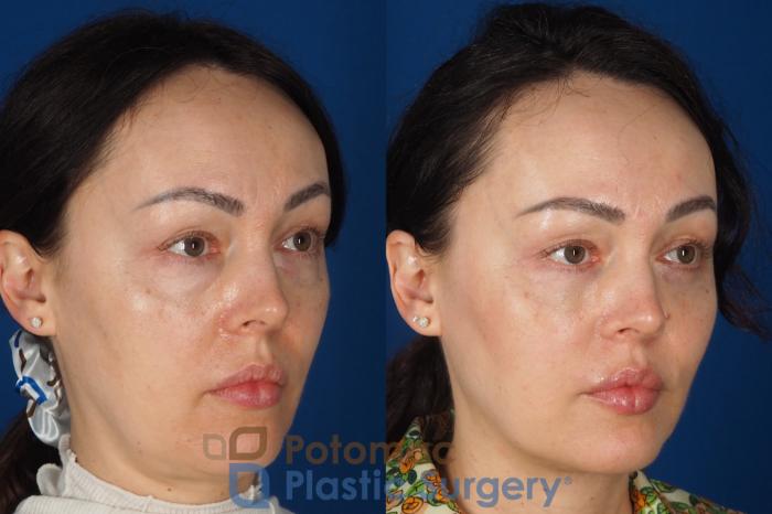 Before & After Blepharoplasty (Eyelid Surgery) Case 356 Right Oblique View in Washington DC & Arlington , DC