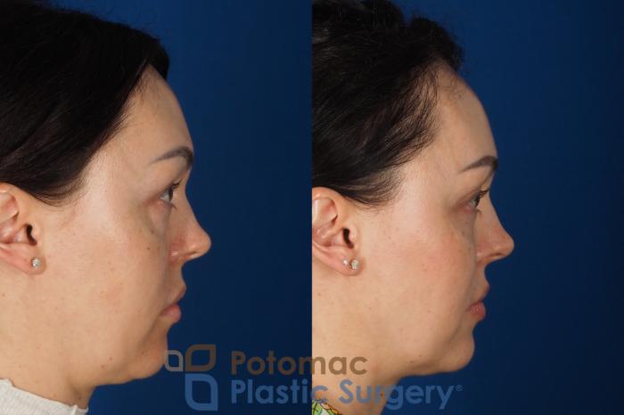 Before & After Blepharoplasty (Eyelid Surgery) Case 356 Right Side View in Washington DC & Arlington , DC