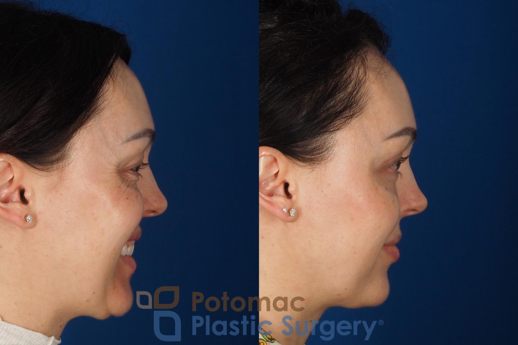 Before & After Blepharoplasty (Eyelid Surgery) Case 356 Right - Smiling View in Washington DC & Arlington , DC