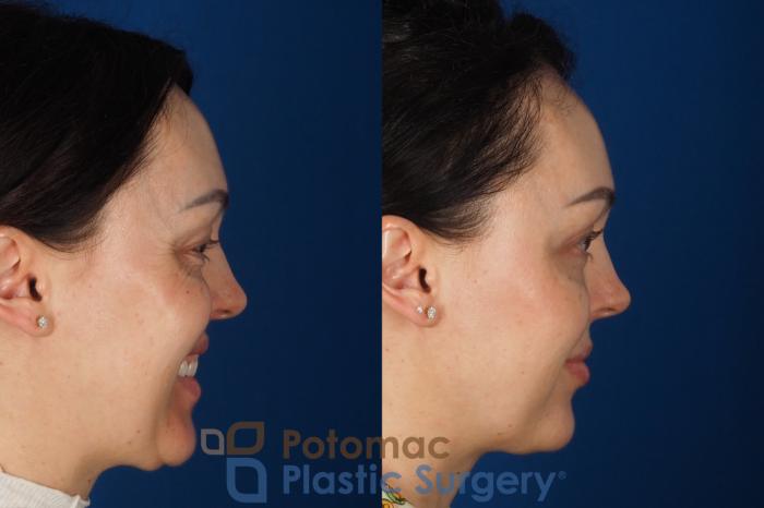 Before & After Blepharoplasty (Eyelid Surgery) Case 356 Right - Smiling View in Washington DC & Arlington , DC