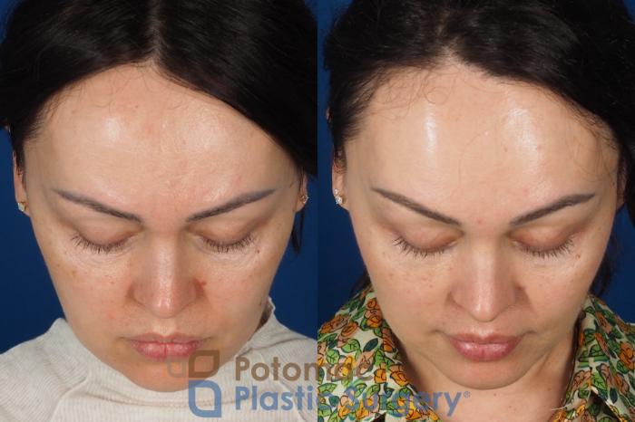 Before & After Blepharoplasty (Eyelid Surgery) Case 356 Top View in Washington DC & Arlington , DC