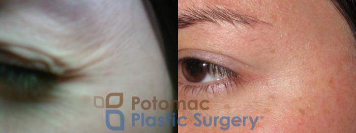 Before & After Botox Cosmetic Case 12 Left Side View in Washington DC & Arlington , DC