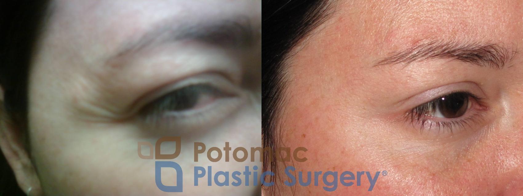 Before & After Botox Cosmetic Case 12 Right Side View in Washington DC & Arlington , DC
